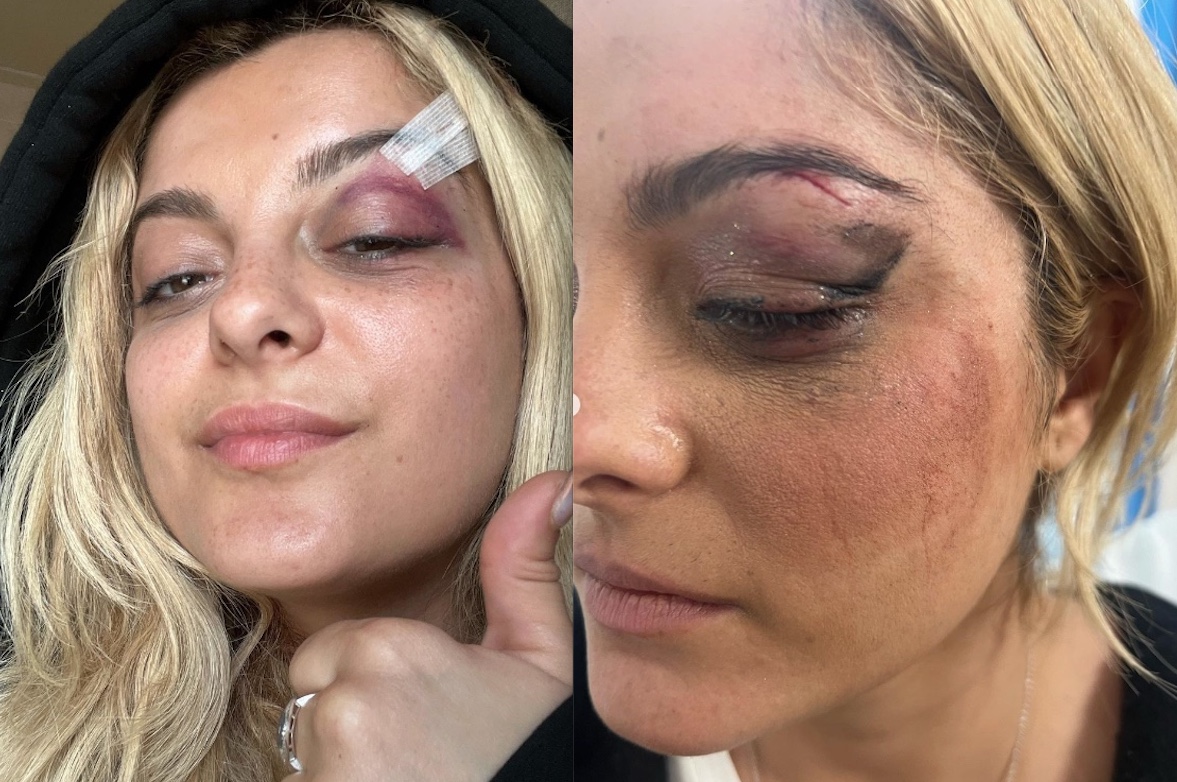 Bebe Rexha mostra como ficou rosto após ser atingida por celular em show