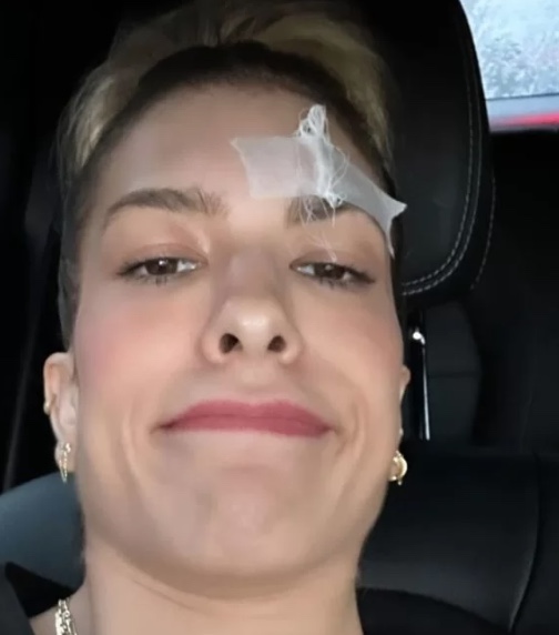 Lore Improta sofre acidente doméstico e leva pontos no rosto