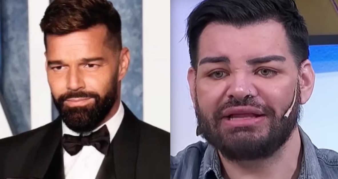 Argentino faz mais de 30 cirurgias para se parecer com Ricky Martin 