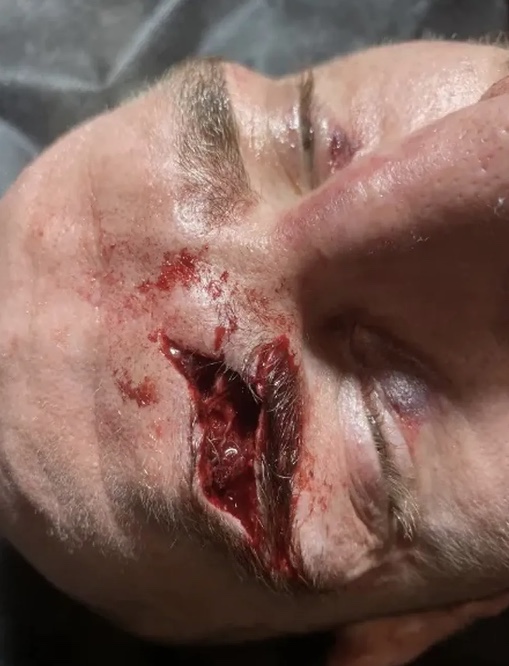 Imagem forte: Lutador sérvio sofre corte profundo na testa no KSW 84