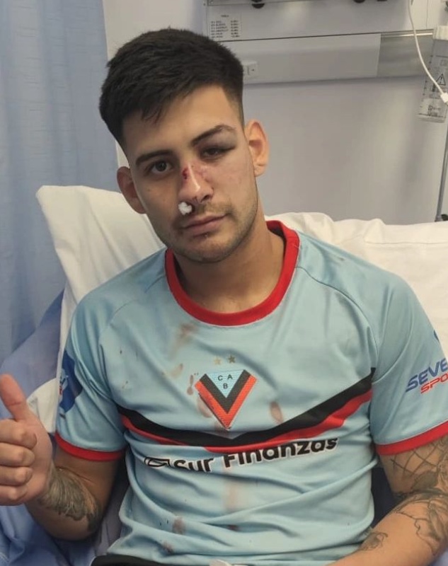 Jogador fratura o nariz após levar chute no rosto na Argentina