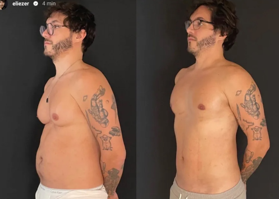 Ex-BBB Eliezer mostra resultado de lipoaspiração redução de mamas