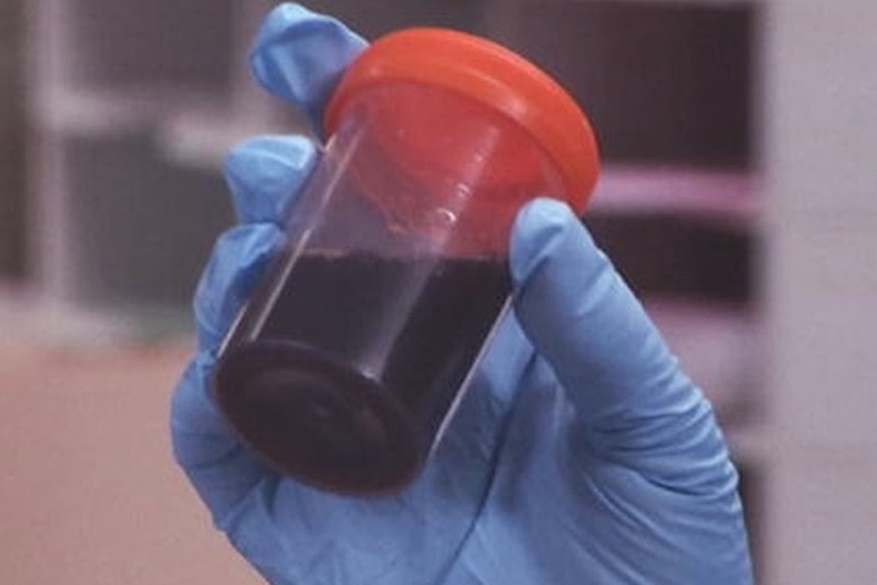 Sobe número de casos da doença da urina preta no Amazonas