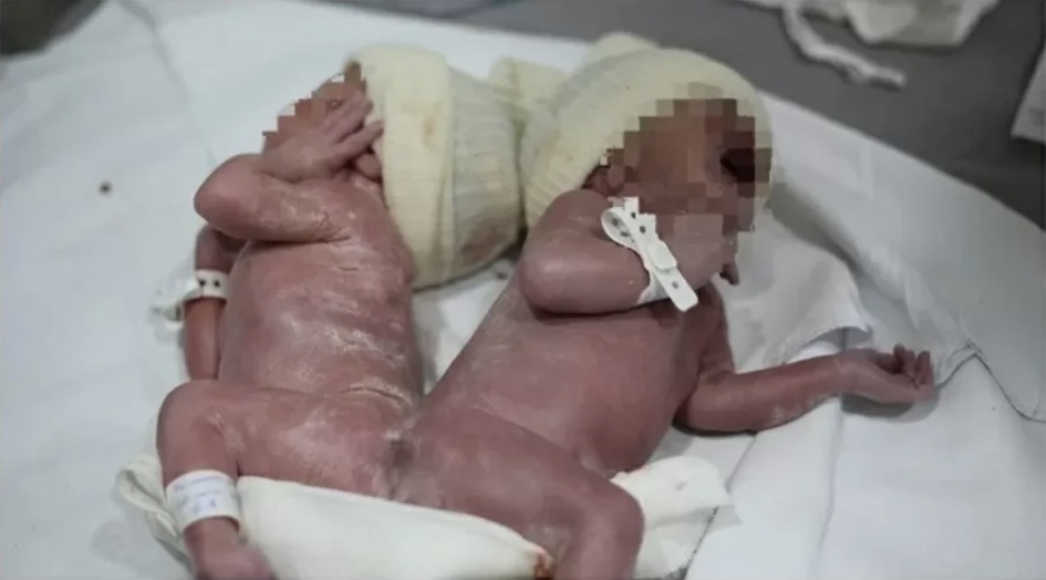 Gêmeos siameses nascem unidos pela coluna; caso é considerado raro