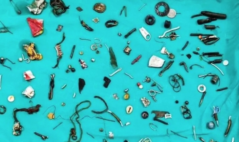 Médicos retiram 60 objetos de estômago de paciente