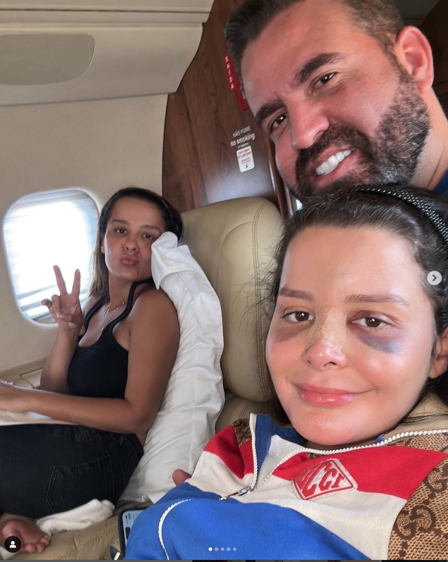 Maraisa aparece com olho roxo e nariz quebrado após acidente em resort