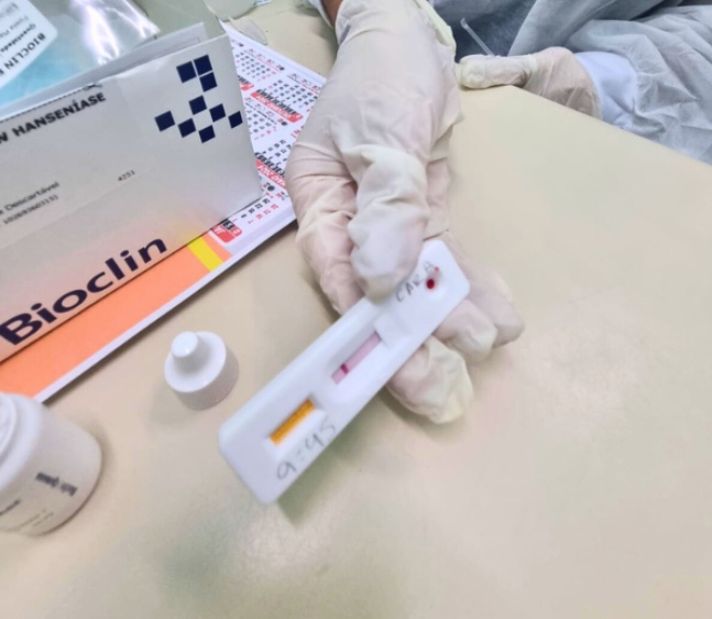 Fundação Alfredo da Matta inicia testagem rápida de Hanseníase