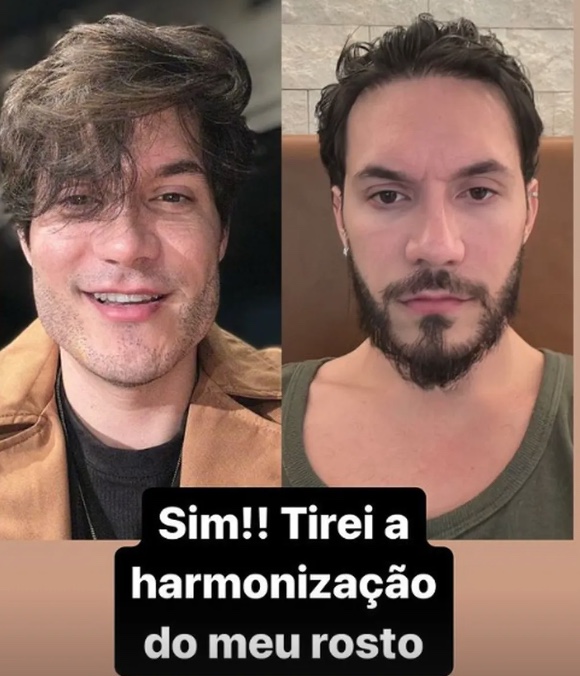 Eliezer desfaz harmonização facial: ‘foi uma grande distorção de imagem’