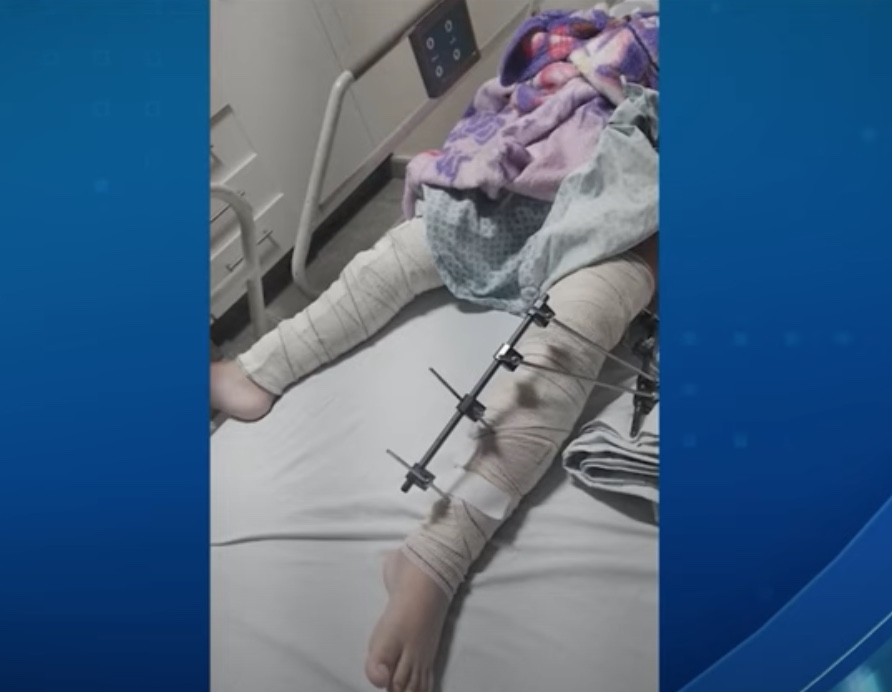 Médicos se confundem e menina de 6 anos tem pinos colocados em perna errada