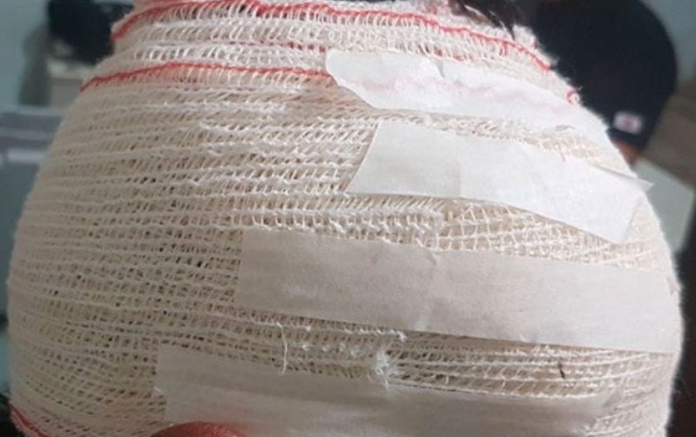 DPU pede seguro a vítimas de escalpelamento, acidente comum na região amazônica