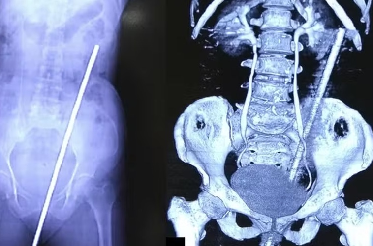 Mulher escorrega e fica com ferro de 60 centímetros no reto