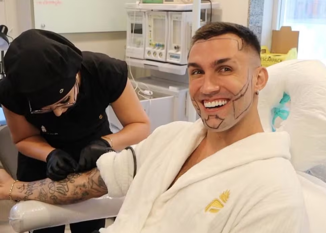 Arthur Piccoli faz transplante de cabelo e barba; fotos