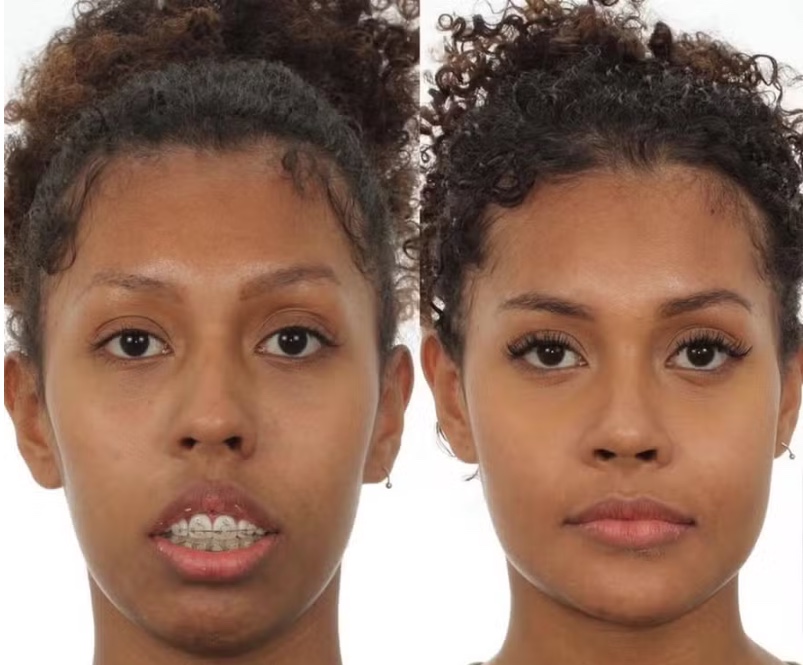 Veja antes e depois de cirurgia de Giovanna Jacobina, irmã de Gracyanne 