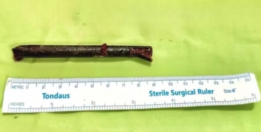 Homem fica com hashi cravado na narina após esbarrar em amigo