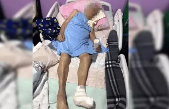 Idosa de 103 anos tem pé amputado sem anestesia em cirurgia em casa
