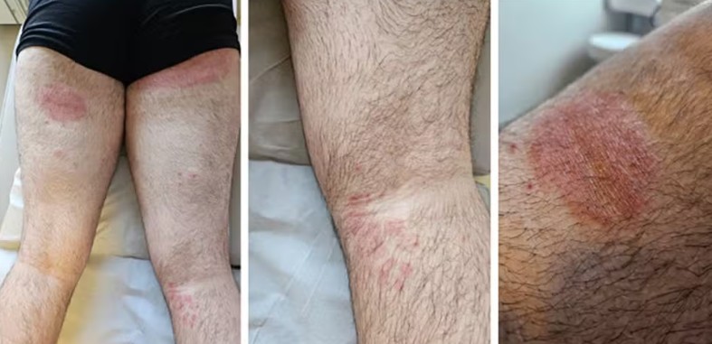 Brasil registra primeiro caso de fungo super-resistente em São Paulo