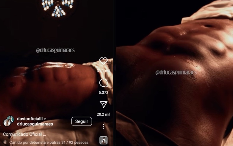 Davi Brito mostra resultado de lipo HD 