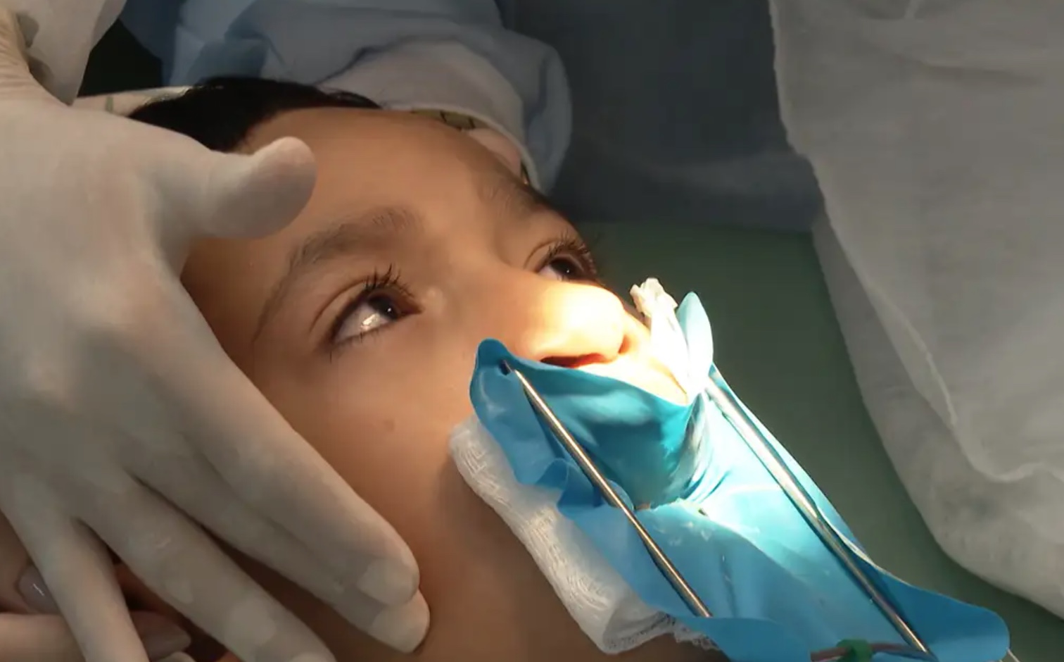 Lula sanciona lei que obriga SUS a fazer cirurgia para lábio leporino