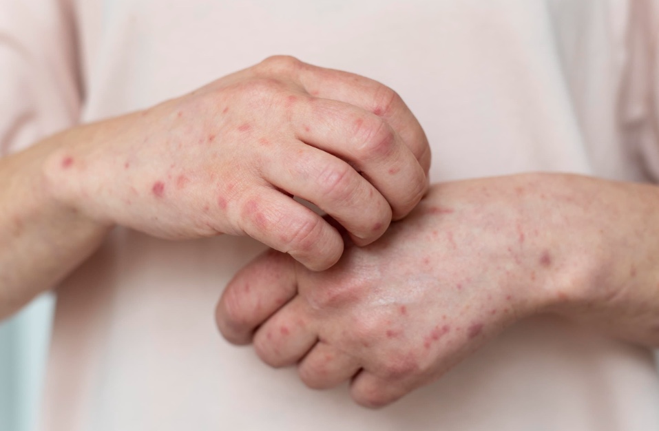 MPAM dá 15 dias para Tapauá explicar ações contra Mpox