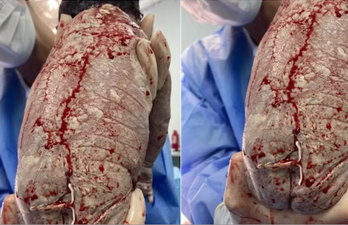 Contraceptivo falha e bebê nasce com DIU acoplado no corpo