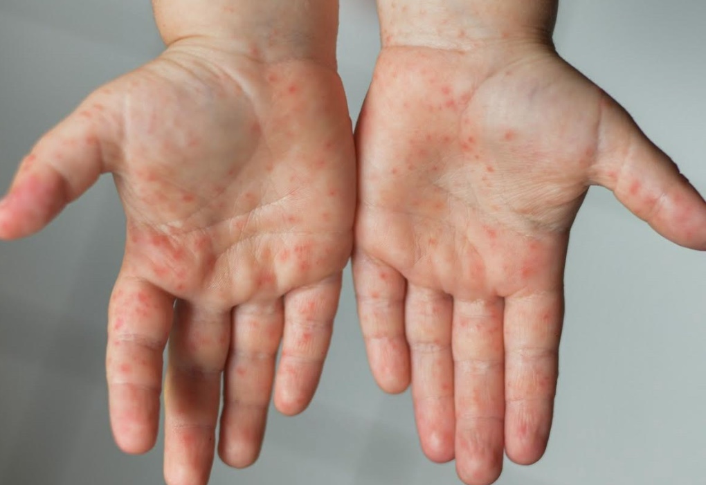 Semsa alerta para alta transmissão da doença mão-pé-boca em Manaus