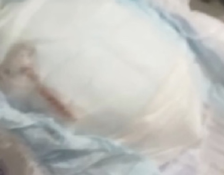 Perícia descarta rato em fralda de bebê; saiba o que era
