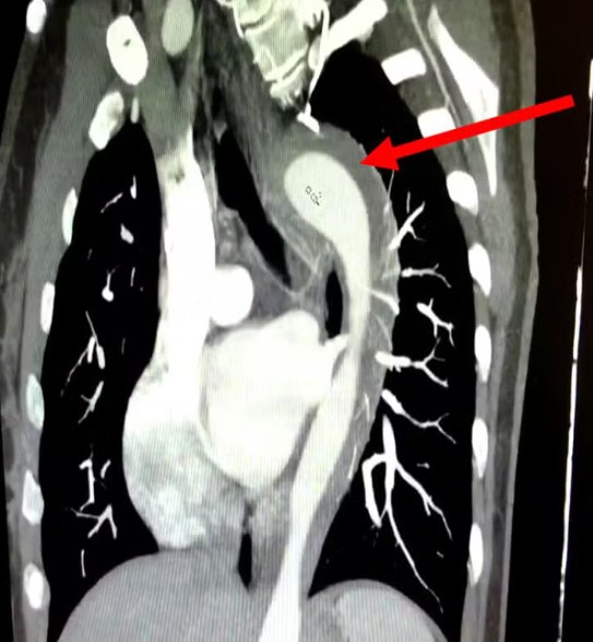 Caso raro: Mulher rompe aorta durante relação sexual