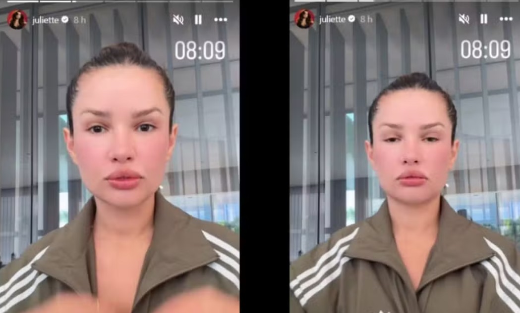 Juliette surge com rosto inchado após tratamento com ‘esperma de salmão’