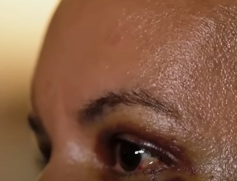 Mulher agredida com 61 socos em elevador recebe alta após cirurgia