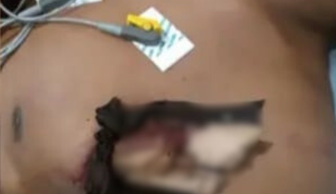 Jovem sofre perfuração no tórax durante corte de árvore em Barcelos