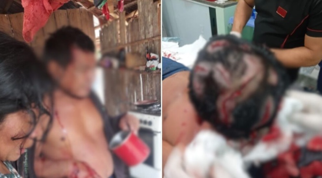 Cacique atacado por onça no Amazonas teve couro cabeludo dilacerado