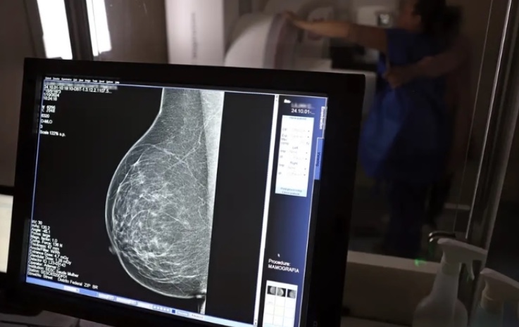 Câmara aprova projeto para garantir mamografia anual no SUS a partir dos 40 anos