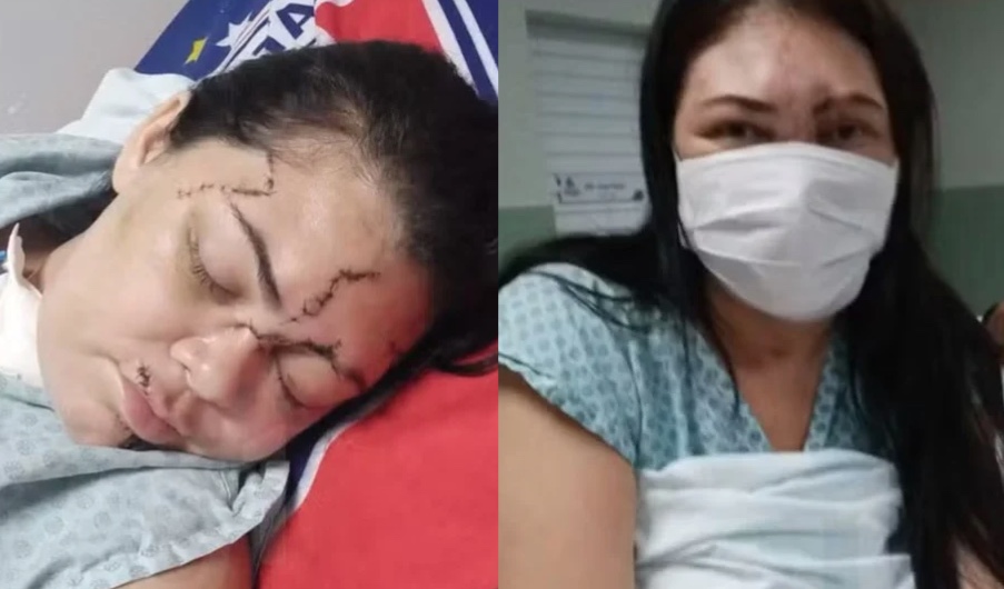 Mulher é agredida com martelo pelo ex e passa 13 dias em coma no Ceará