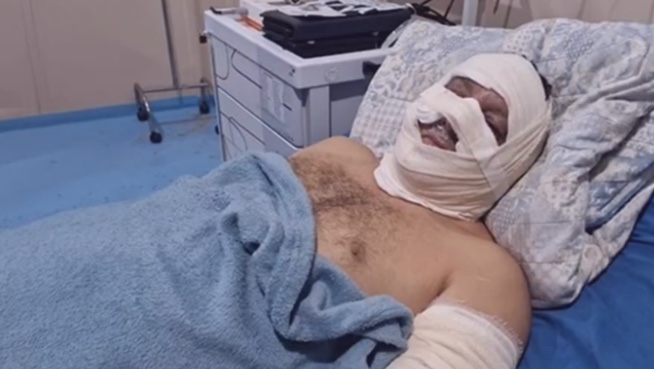 Veja estado do ex-prefeito de Borba após explosão em lancha 