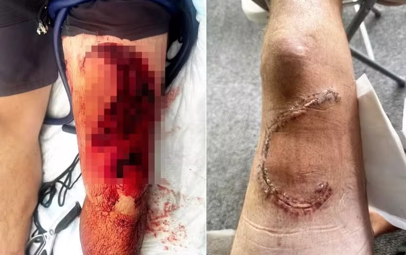 Pescador tenta salvar tubarão e acaba sendo mordido por ele no Havaí