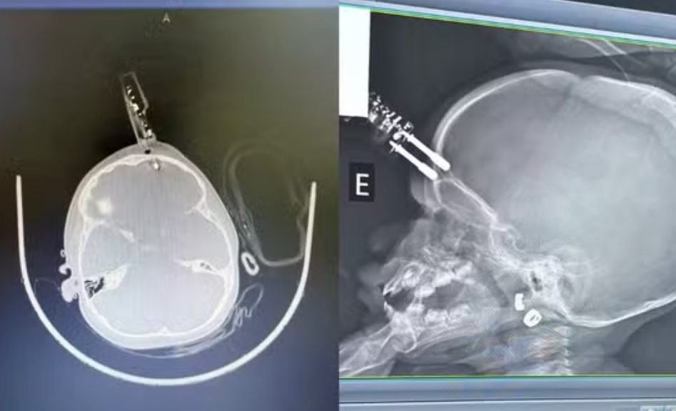 Bebê de 1 ano cai da cama e fica com carregador cravado na testa em MG