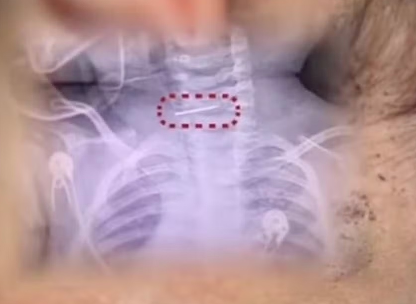 Mulher fere bebê 600 vezes com agulha na China como forma de "punição" 