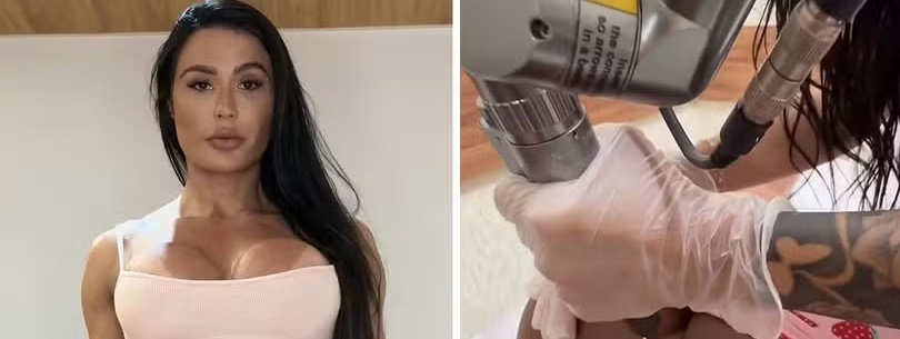 Veja como ficou remoção de tatuagem íntima de Gracyanne Barbosa