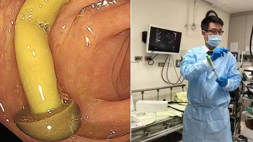 Médico encontra cogumelo crescendo em intestino de paciente