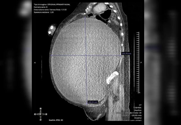 Paciente que acreditava estar obesa tira 5 quilos de cisto do ovário