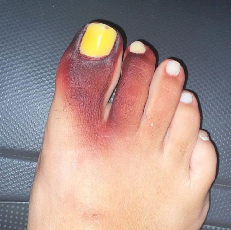 Mulher fica com pé roxo e unha amarela após contato com piolho-de-cobra