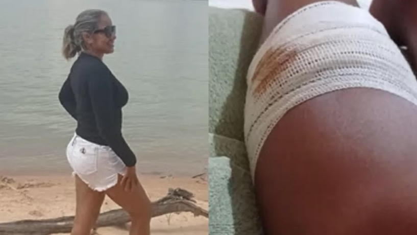 Mulher tem perna dilacerada após ataque de piranha