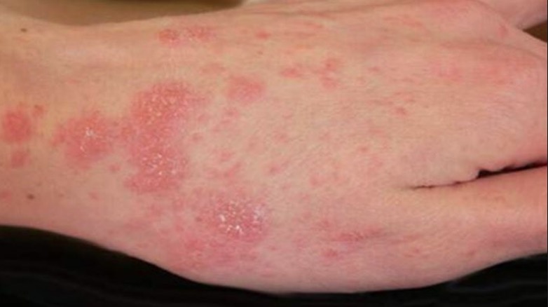 Casos de sarna humana voltam a surgir no Brasil; saiba tudo sobre a doença