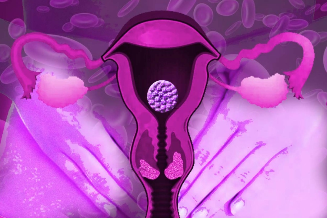 Câncer de colo do útero é o 3º que mais mata mulheres; saiba como se prevenir