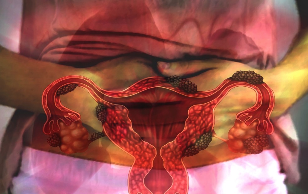 Até 40% das mulheres com endometriose têm dificuldades para engravidar