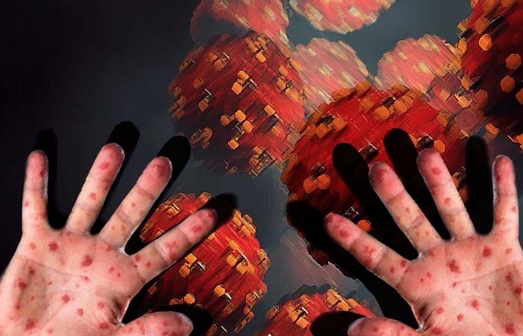 Sarampo tem taxa de transmissão maior que Covid-19 no Brasil