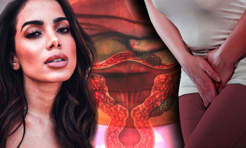 Endometriose: entenda sintomas e tratamento da doença de Anitta