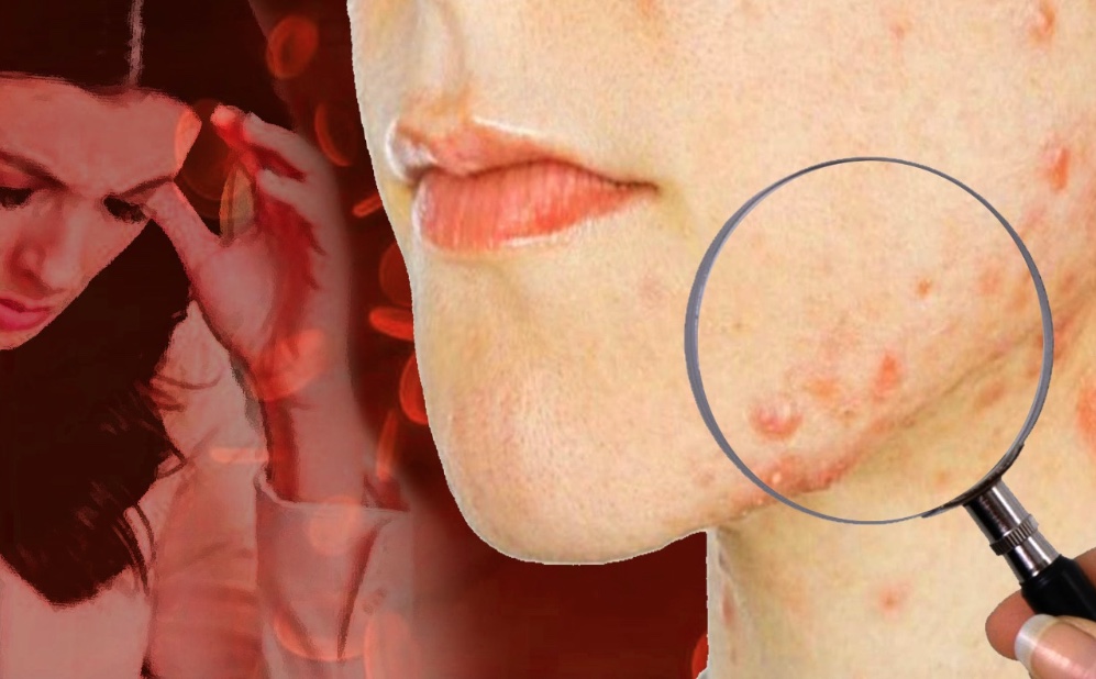 De dermatite a acne: entenda a relação do estresse e as reações na pele
