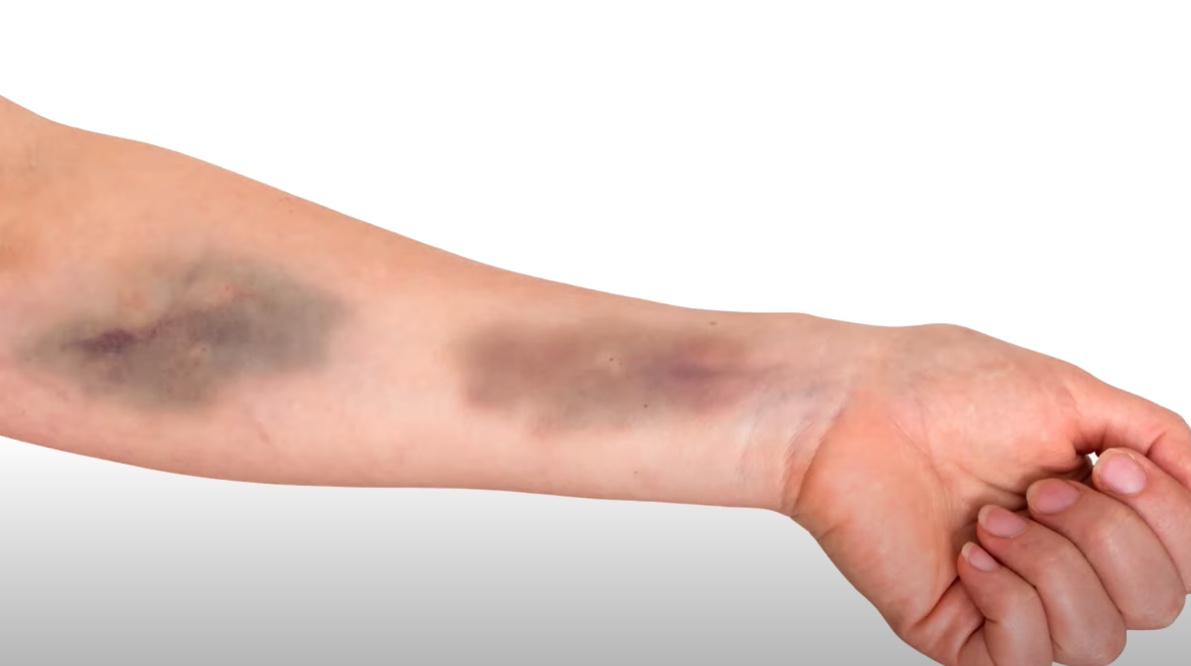 Entenda causas das manchas roxas no corpo e quando é grave