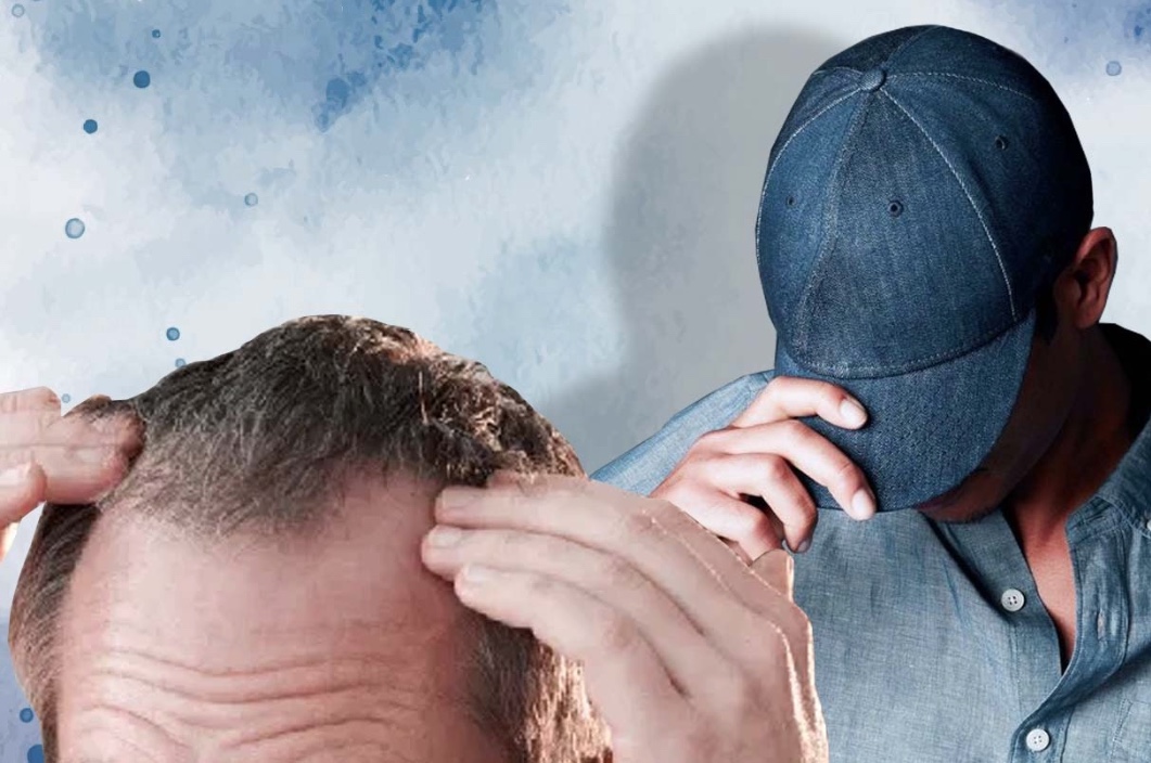 Uso de boné, genética ou estresse? Entenda causas da calvície